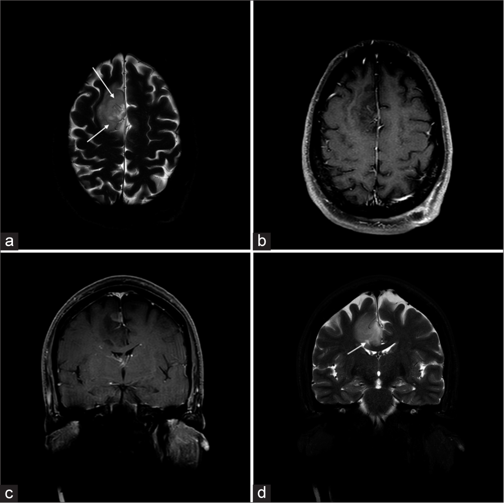 A 45-year-old male with anaplastic astrocytoma grade III, with IDH ½ mutation. (a) Axial and (b) coronal T2-weighted images show a T2 hyperintense mass centered on the left superior frontal gyrus. Internal vessels are evident as curvilinear dark flow voids (white arrows). On the (c) axial and (d) coronal T1+C images, mass is predominantly non-enhancing, with a small enhancing nodular component (asterisk). Previously seen vascular flow voids correspond to linear foci of enhancement (white arrows). IDH: Isocitrate dehydrogenase.