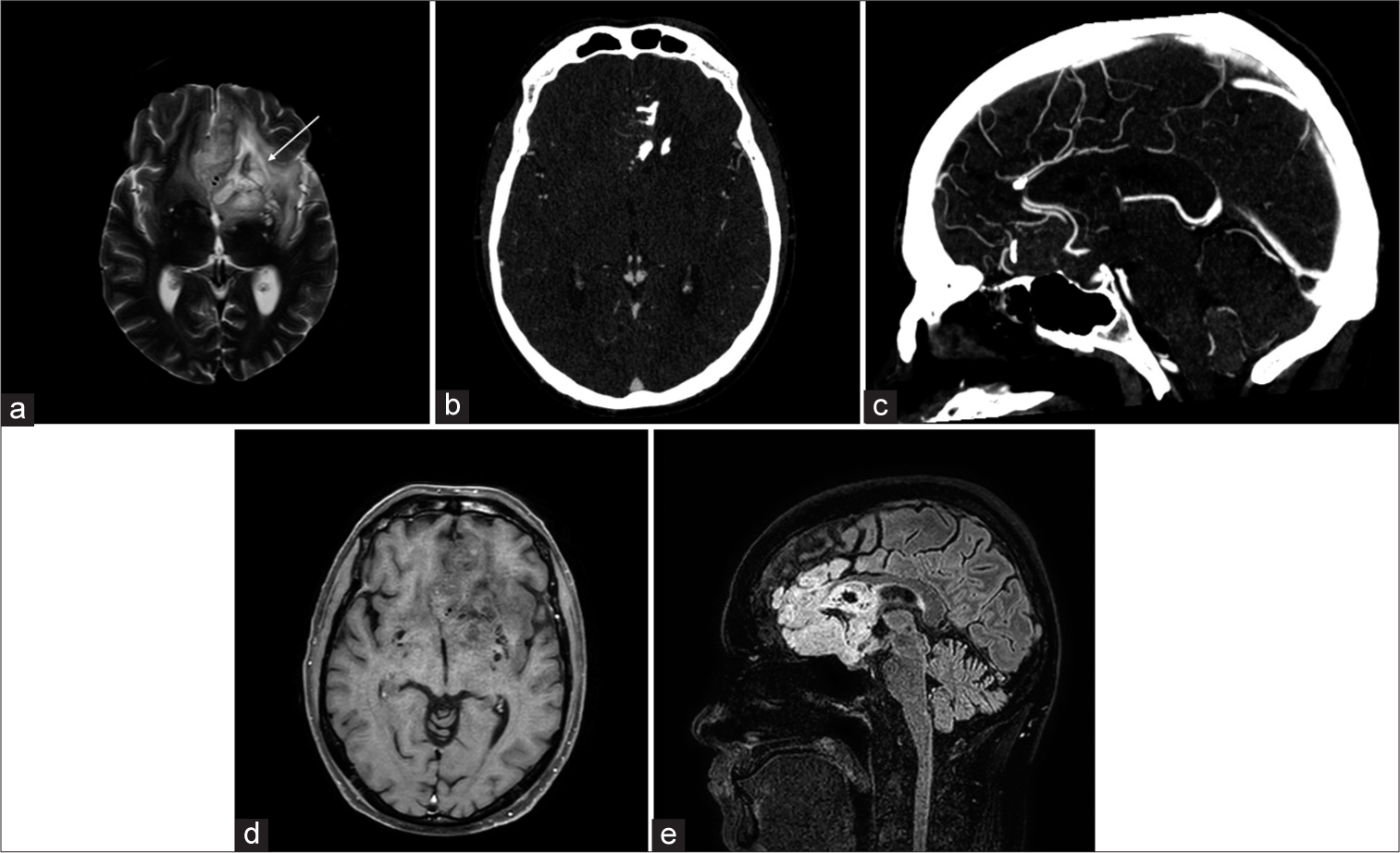 A 39-year-old male with anaplastic oligodendroglioma, with 1p/19q codeleted, IDH mutation. (a) Axial T2-weighted image shows a left frontal mass which encases the traversing bilateral anterior cerebral arteries (white arrow). (b) Axial and (c) sagittal computed tomography angiogram demonstrates characteristics internal calcifications in the mass and confirms the presence of ACAs medially. The ACA flow voids are also evident on the (d) axial T1+C and (e) sagittal FLAIR images. IDH: isocitrate dehydrogenase, ACA: Anterior cerebral artery, FLAIR: Fluid-attenuated inversion recovery.