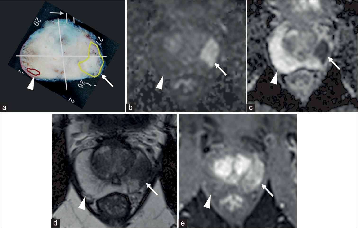 (a) Pathological map of PC, (b-e) mpMRI; (b) DWI, (c) ADC map, (d) T2WI, and (e) DCE. (a) Two lesions, one yellow and one brown, were detected on the pathological map of PC. The yellow lesion (white arrow) in the left peripheral zone showed hyperintensity on DWI, hypointensity on ADCmap, hypointensity on T2WI, and early enhancement on DCE. The yellow lesion (white arrow) was assessed as PI-RADS category 5 and classified as MRI-detectable PC. In contrast, the brown lesion (white arrow head) in the right peripheral zone showed no abnormal signal on mpMRI. The brown lesion (white arrow head) was assessed PIRADS categories 1 and classified as MRI-undetectable PC. (ADC: Apparent diffusion coefficient, DCE: Dynamic contrast-enhanced, MRI: Magnetic resonance imaging, DWI: Diffusion-weighted imaging, mpMRI: multiparametric magnetic resonance imaging, PC: Prostate cancer, T2WI: T2-weighted imaging, PI-RADS: Prostate imaging reporting and data system.)