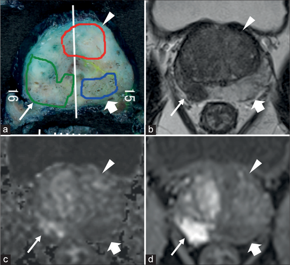 (a) Pathological map of PC, (b-d) mpMRI; (b) T2WI, (c) DWI, and (d) DCE. (a) Three lesions, one green, one red, and one blue, were detected on the pathological map of PC. (a) The white line is the excision line of the specimen. The Gleason score for all three lesions were 9 (4+5). The green lesion (thin white arrow) was MRI-detectable csPC, approximately 43 mm × 10 mm in size. The red lesion (white arrow head) and blue lesion (thick white arrow) lesions were MRI undetectable csPC, approximately 20 mm × 8 mm and 19 mm × 5 mm in size, respectively. (DCE: Dynamic contrast-enhanced, MRI: Magnetic resonance imaging, DWI: Diffusion-weighted imaging, mpMRI: Multiparametric magnetic resonance imaging, PC: Prostate cancer, T2WI: T2-weighted imaging, csPC: Clinically significant prostate cancer).