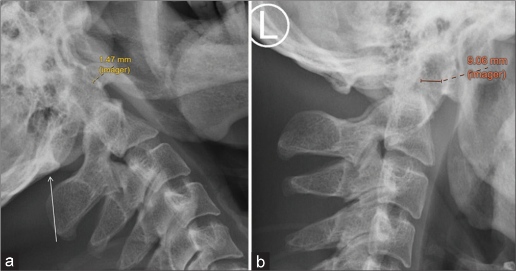 (a) Extension radiograph of the cervical spine showing posterior arch assimilation (white arrow). The atlantodental interval is within normal limits under extension view, measuring 1.47 mm. (yellow measurement calipers). (b) Flexion cervical spine radiograph of the same patient showed an atlanto-dental interval with marked widening, measuring 9.06mm (orange measurement calipers), suggestive of atlantoaxial subluxation. Atlanto-axial subluxation may be missed if dynamic flexion and extension study is not performed.