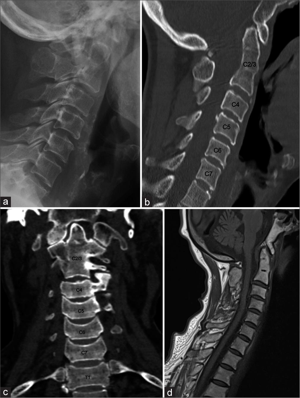 (a) Plain radiograph of the cervical spine showing anterior arch assimilation. Associated fusion of C2 and C3 vertebral bodies and posterior elements were noted. The atlantodental interval is within normal limits. No basilar invagination was seen. (b) Annotated computed tomography (CT) of the cervical spine, confirming the findings on plain radiograph. Notice the relatively ‘elongated’ appearance of the dens, supporting the diagnosis of C2/3 fusion. (c) Coronal reformatted CT of the cervical spine showing C2/3 fusion. The first rib-bearing thoracic vertebral body is labeled as T1. (d) T1W magnetic resonance imaging of the cervical spine, confirming previous findings. The cervical cord is not compressed.