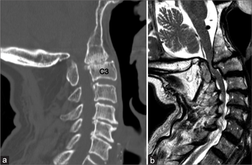 (a) Computed tomography (CT) of the cervical spine showing atlanto-occipital assimilation with anterior and posterior arches assimilation. Fusion between the dens, assimilated C1, and clivus was seen. C3 is being labeled as a reference. Marked narrowing of the spinal canal was noted. (b) Subsequently arranged sagittal T2-weighted magnetic resonance imaging confirming CT findings and showing cord compression.