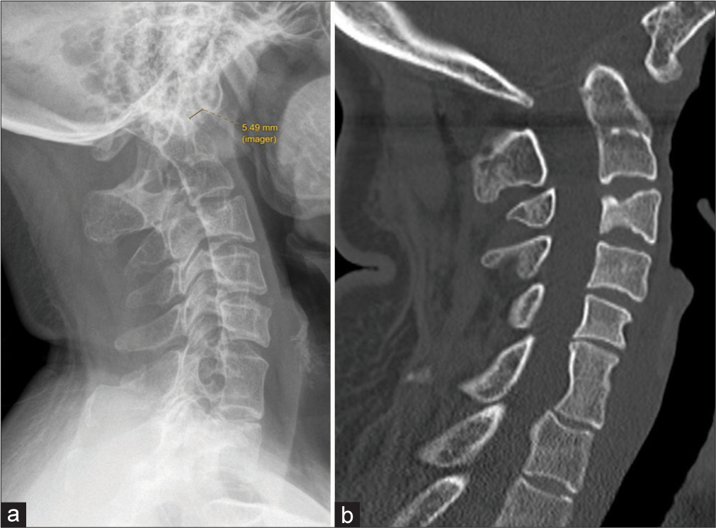 (a) Lateral X-ray of cervical spine, showing atlanto-occipital assimilation with anterior arch assimilation. Fusion between the C6/7 vertebral bodies was noted. Associated atlantoaxial subluxation (atlantodental interval measuring 5.49 mm) and basilar invagination are also seen. (b) Sagittal computed tomography in bone window confirming the findings on plain radiograph. Note the wasp-waist appearance of the fused C6/7 vertebral bodies, suggesting a congenital fusion of the cervical spine rather than secondary causes (e.g., prior discitis and surgical fusion).
