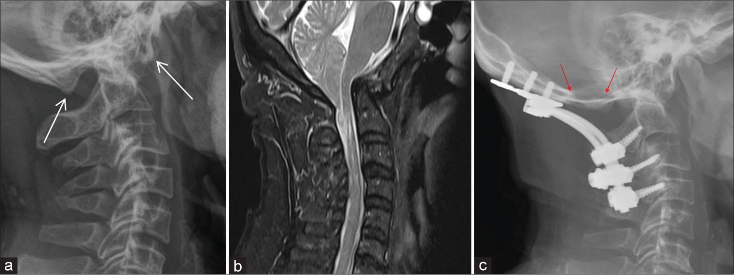 (a) Plain radiograph of the cervical spine showing assimilation of anterior and posterior arches. (white arrows) Associated type 1 basilar invagination noted. (b) Sagittal T2-weighted magnetic resonance imaging of the same patient showing Chiari I malformation with descent of cerebellar tonsils beyond the foramen magnum. Note the peg-like configuration of the cerebellar tonsil. Associated compression on the cervicomedullary junction of the spinal cord was noted. There are also cord edema and syrinx formation. (c) Plain radiograph of the cervical spine of the same patient showing occipito-cervical fusion with metallic screws, plates, and rods. Occipitocervical fusion can provide atlantoaxial stability and is a procedure commonly performed for symptomatic atlanto-occipital assimilation. Also, notice the defect at the occipital bone (red arrows). The patient also had concomitant suboccipital craniectomy and expansile duroplasty for treatment of Chiari I malformation. The procedure is to create space for the herniated cerebellar tonsil since the pathogenesis of Chiari I malformation is believed to be due to a mismatch between the size and content of the posterior fossa (i.e., a congenitally small posterior fossa).