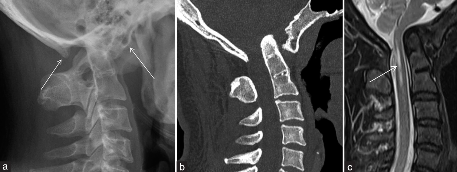 (a) Lateral cervical spine radiograph showing assimilation of both the anterior arch and posterior arch of C1 (white arrows). Associated basilar invagination noted. Notice the relatively “elongated” appearance of the dens, raising suspicion for underlying C2/3 fusion. The cervical canal is markedly narrowed, worrisome of cord compression. (b) Sagittal computed tomography (CT) in bone window confirms the findings in the radiograph. Notice the fusion of C2 and C3 vertebral bodies and posterior elements. (c) Sagittal T2 weighted magnetic resonance imaging confirming findings in CT and plain radiograph. Compression on the cervicomedullary junction of the spinal cord was noted, with cord edema and syrinx formation seen (white arrow).