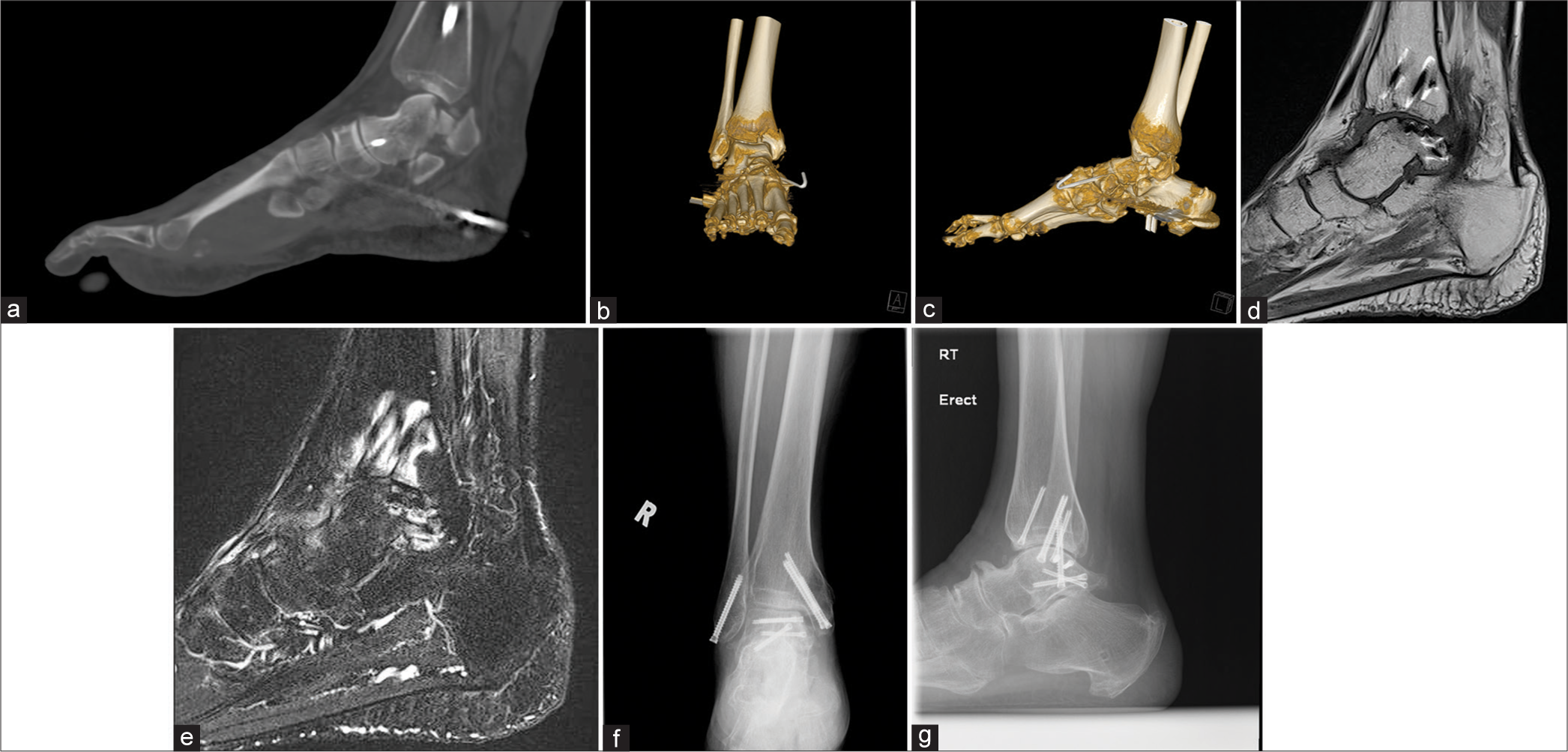 A 63 year-old female sprained her right ankle during hiking resulting in subtalar medial dislocation. CT scan in (a) lateral view and three-dimensional reconstruction images in (b) anteroposterior and (c) lateral views showed previous open reduction and internal fixation, and associated bimalleolar fracture as well as intra-articular talar fracture involving the sinus tarsi. (d) MRI in T1-weighted and (e) T2-weighted fat-saturated sequences lateral views reviewed fat obliteration and edema at the sinus tarsi. Follow-up radiograph in (f) anteroposterior and (g) lateral views at 31 months after injury showed grade III osteoarthritis involving subtalar, talotibial and talonavicular joints. (MRI: Magnetic resonance imaging, CT: Computed tomography, RT, R: right)