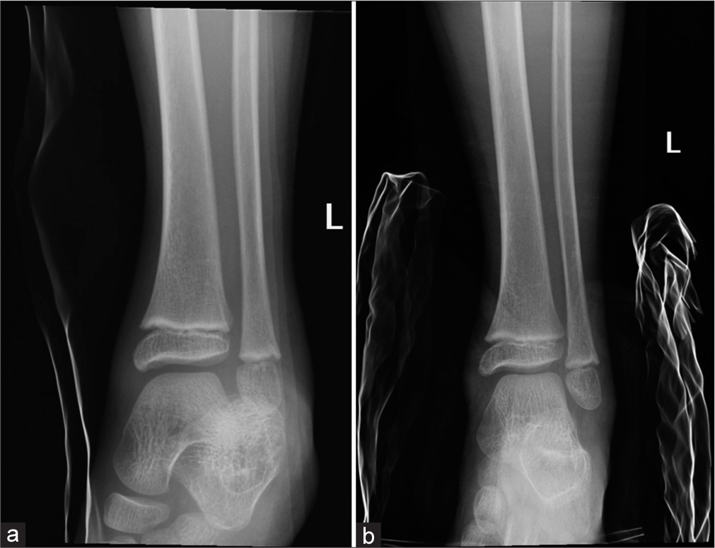 A 8 year-old female sustained a left ankle injury during cycling where her ankle was trapped in the wheel. Radiographs in (a) anteroposterior view showed subtalar lateral dislocation, (b) which was successfully reduced. (L: left)