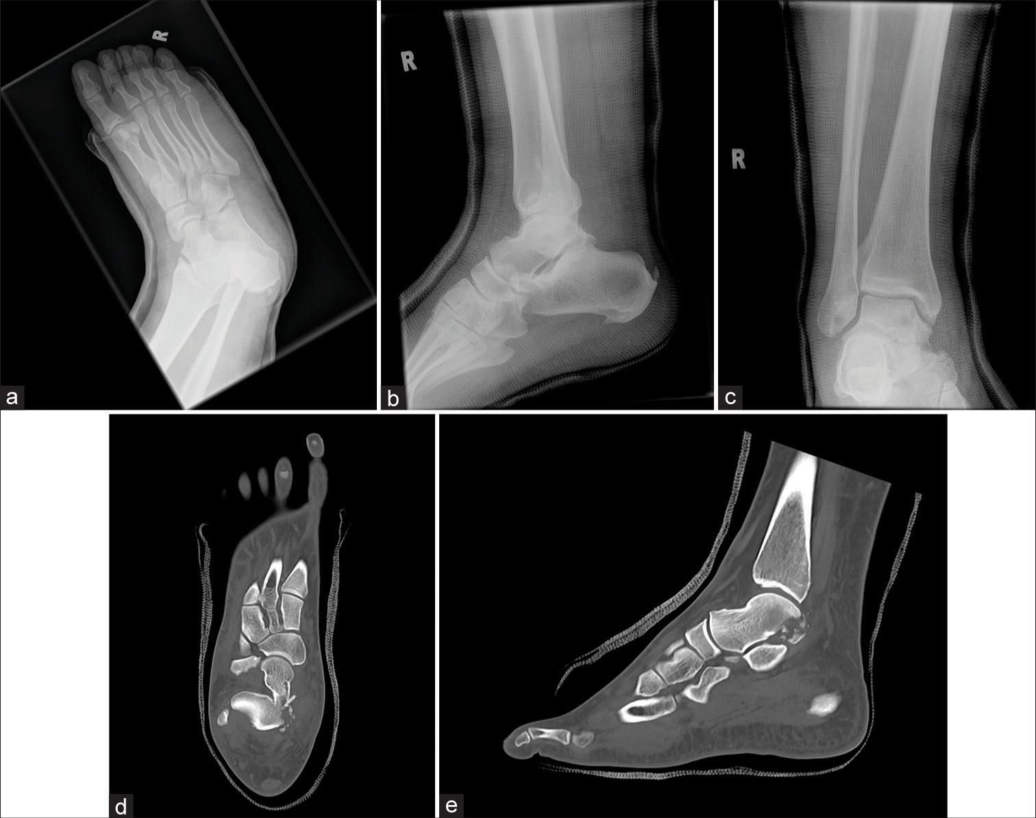 A 41 year-old male sustained a right subtalar medial dislocation during a basketball game. Conventional radiographs performed after reduction in (a) oblique, (b) lateral and (c) frontal views did not reveal obvious fracture. CT in (d) axial and (e) lateral showed comminuted fracture of the talus involving the medial tubercle and posterior process, which were not visible on conventional radiographs. (R: Right)