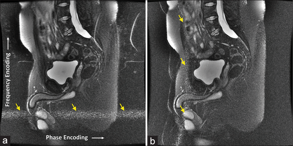 (a) Abdomen magnetic resonance (MR) image with radiofrequency interference artifact (labeled by yellow arrows) caused by damaged shielding in the MR scanner room door. (b) The direction of the artifact (labeled by yellow arrows) changed with the swapping of frequency and phase encoding directions in the image acquisition.