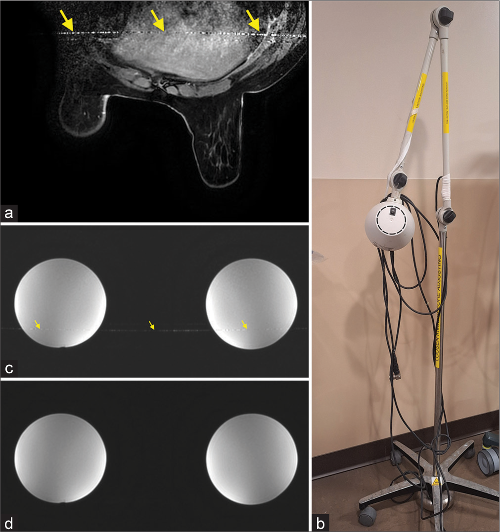 (a) A breast image with radiofrequency interference artifact (yellow arrows) caused by (b) a lamp inside the magnetic resonance (MR) scanner room with the power cord fed through the waveguide and connected to a power outlet in the control room. Phantom testing verified that the (c) artifact (yellow arrows) was caused by the power cord and (d) the artifact was eliminated after the power cord was pulled back completely into the MR scanner room.