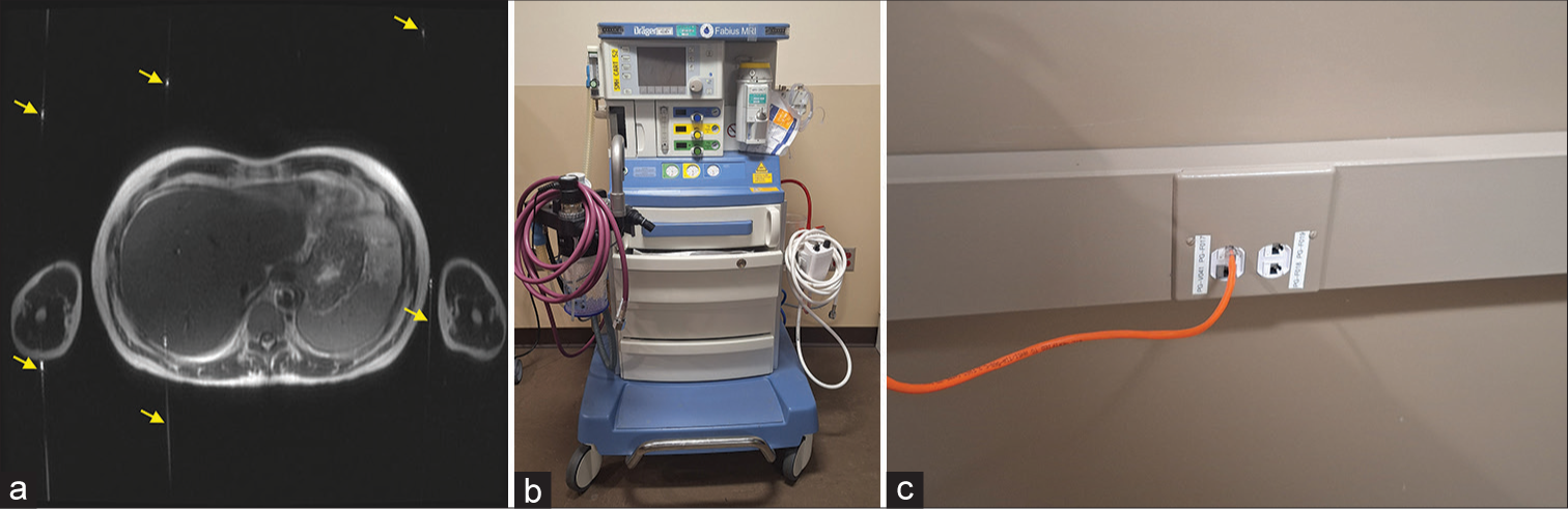 (a) Abdomen magnetic resonance (MR) image with radiofrequency interference artifact (labeled by yellow arrows) caused by (b) an anesthesia machine in the MR scanner room. External radiofrequency field was introduced into the MR scanner room through an internet cable connected to a computer in the control room through the waveguide, leading to the artifact. The artifact problem was solved by first connecting the internet cable from the anesthesia machine to an electrically filtered port inside the MR scanner room and then to the computer using another internet cable plugged into (c) the port on the other side of the wall in the control room.