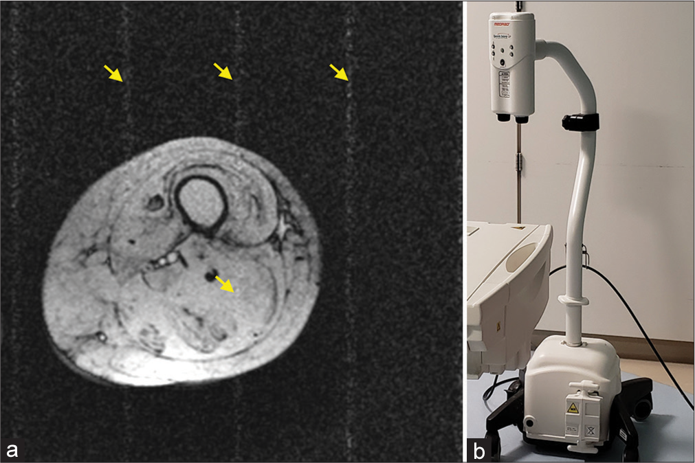 (a) Radiofrequency interference artifact (labeled by yellow arrows) on a leg magnetic resonance (MR) image caused by (b) a power injector inside the MR scan room.