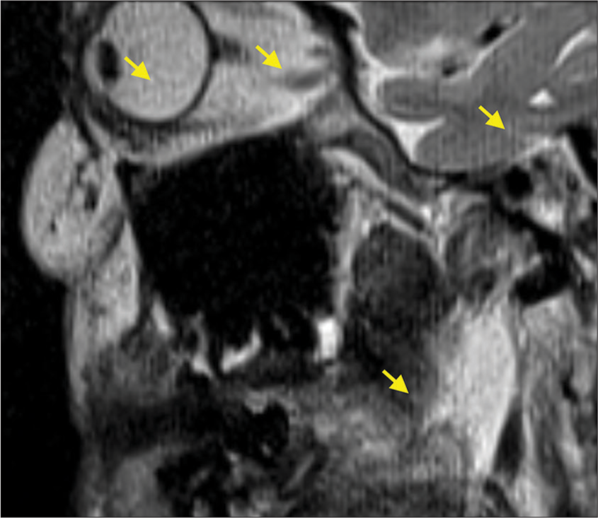 Head magnetic resonance image showing spike artifact (labeled by yellow arrows) across the whole image.