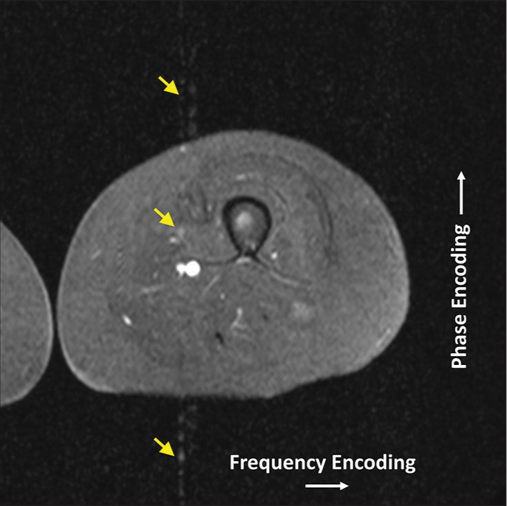 Leg magnetic resonance image with pulsation blood flow artifact (labeled by yellow arrows). Note the artifacts are in line with the blood vessels in the phase encoding direction.