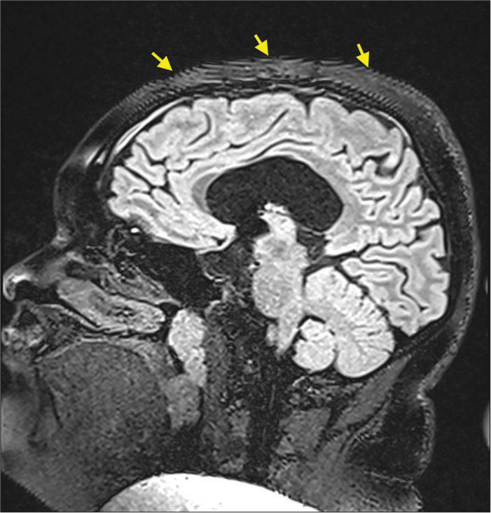 Free induction decay artifact (labeled by yellow arrows) in the subcutaneous fat on top of the head fast-spin-echo magnetic resonance image.