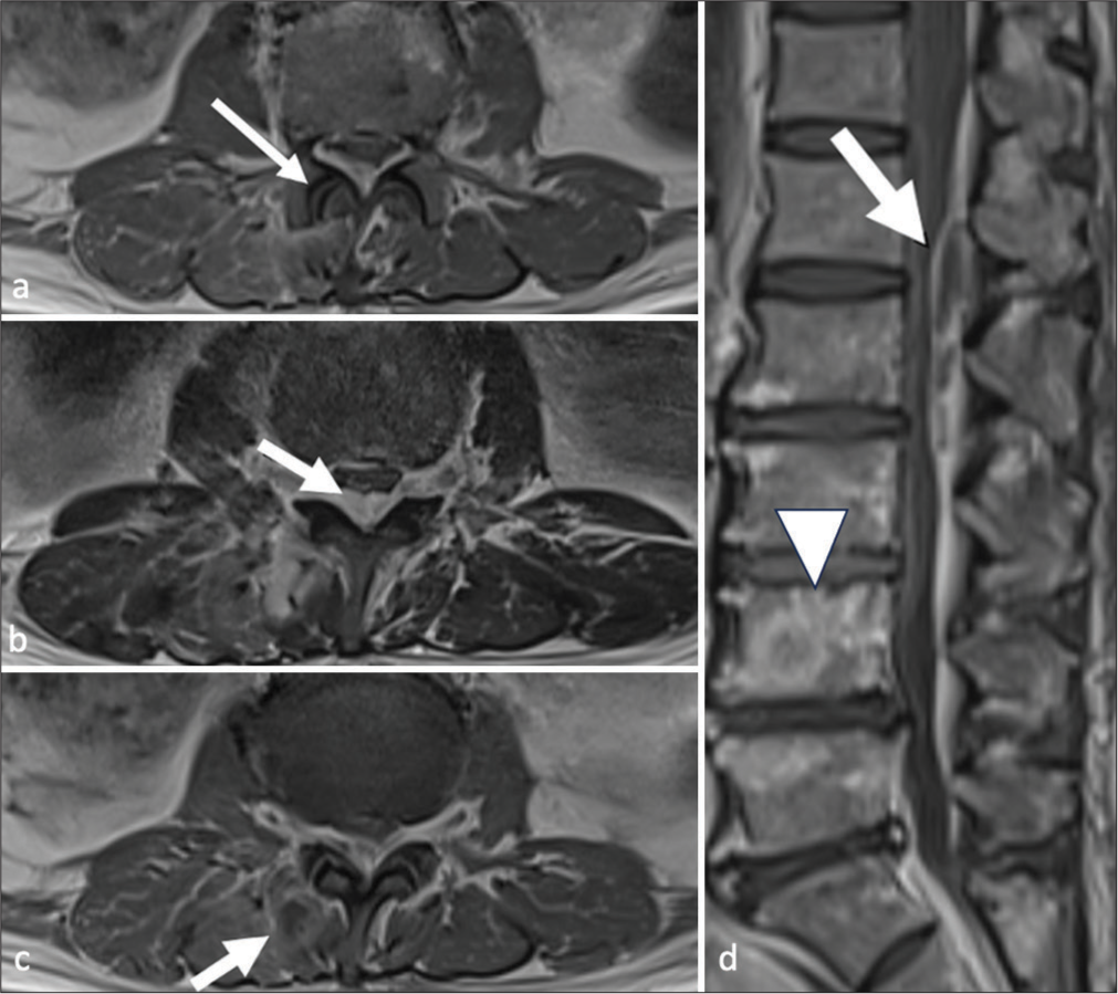 A 61 years old man with a few days’ history of fever and low back pain. (a) Axial T1-weighted non-contrast magnetic resonance (MR) images at right L1/2 level. It showed widening of the right L1/2 level facet joint (white arrow); (b) Axial T2-weighted MR images at L2 level. An epidural abscess (white arrow) compresses on thecal sac causing cauda equina compression; (c) Axial T1-weighted non-fat suppressed gadolinium-enhanced MR images at right L1/2 level. It showed contrast enhancement in swollen right paraspinal muscle with rim-enhancing collection (white arrow) suggestive of paraspinal abscess and reactive inflammatory changes; (d) Sagittal T1 gadolinium-enhanced MR images. An epidural abscess extends from T12 down to L4 levels (white arrow), which are better correlated on axial view. A contrast-enhancing focus in L4 vertebral body (white arrowhead) is likely infective.