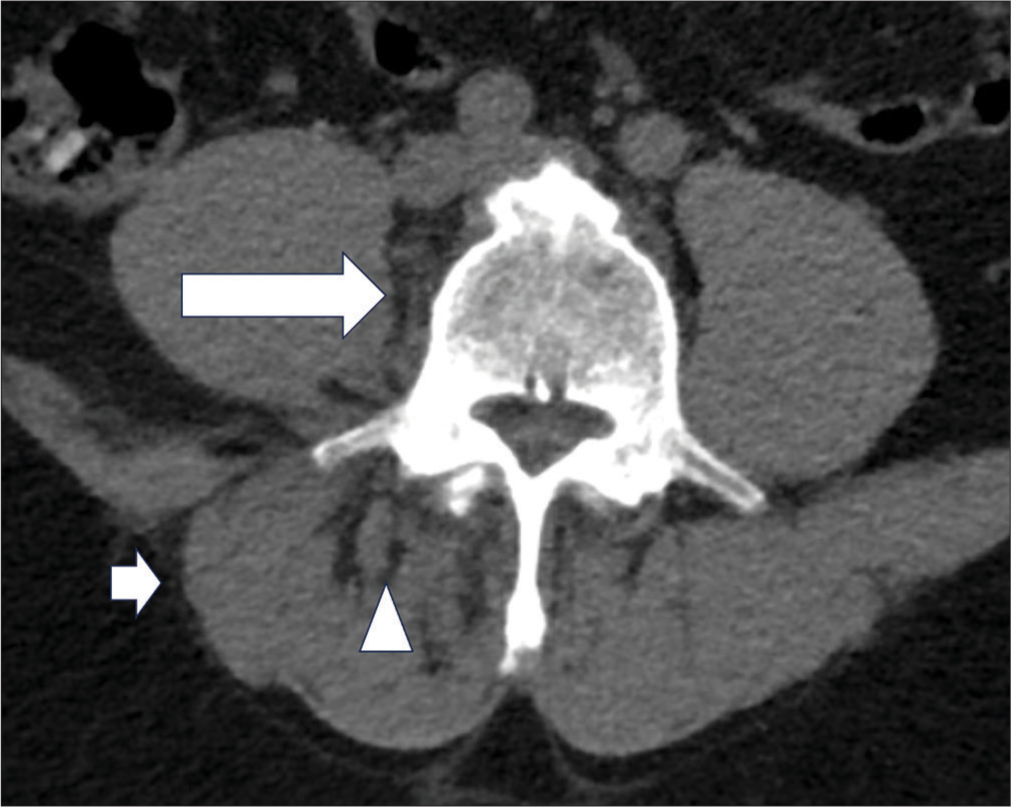 A 50 years old male with 1 week onset of fever, low back pain, bilateral weakness and numbness. Axial images of contrast computed tomography of lumbosacral spine. Subtle increased fat strandings were noted at the right retroperitoneal region adjacent to the L5 and S1 vertebrae (long white arrow). Inflammatory changes were noted over the right erector spinae muscle (white arrowhead). Right erector spinae muscle was mildly swollen (short white arrow).