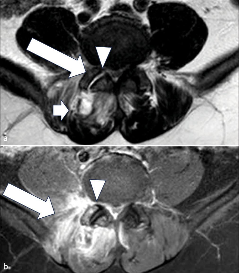 A 60 years old lady with 1 week onset of fever of unknown origin, low back pain and mild bilateral lower limb weakness. (a) Axial T2-weighted non-fat suppressed magnetic resonance (MR) images of lumbosacral spine. There was joint space widening and effusion of the right L5/S1 facet joint (white arrowhead). Abnormal marrow edema was noted at the adjacent articular processes (long white arrow). Right paraspinal muscle edema (short arrow) was also seen; (b) Axial T1-weighted fat suppressed gadolinium-enhanced MR images of lumbosacral spine. Enhancement was seen around the right L5/S1 facet joint (white arrowhead) and paraspinal region (white arrow).