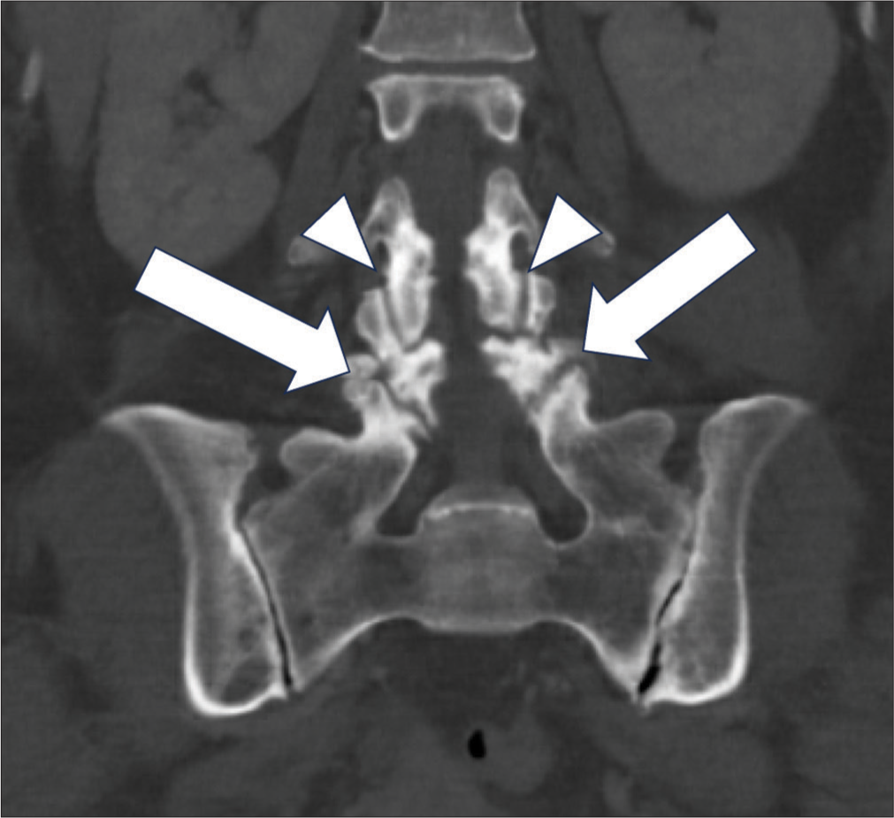 A 60 years old lady with 1 week onset of fever of unknown origin, low back pain and mild bilateral lower limb weakness. Coronal images of computed tomography lumbosacral spine. Sacralization of L5 vertebra was noted. Subchondral irregularity of bilateral L4 and L5 articular processes around the facet joints (white arrows) was misinterpreted as degenerative changes at the time of reporting. Comparatively, smooth subchondral bone at bilateral L3– L4 facet joints was also noted (white arrowheads).