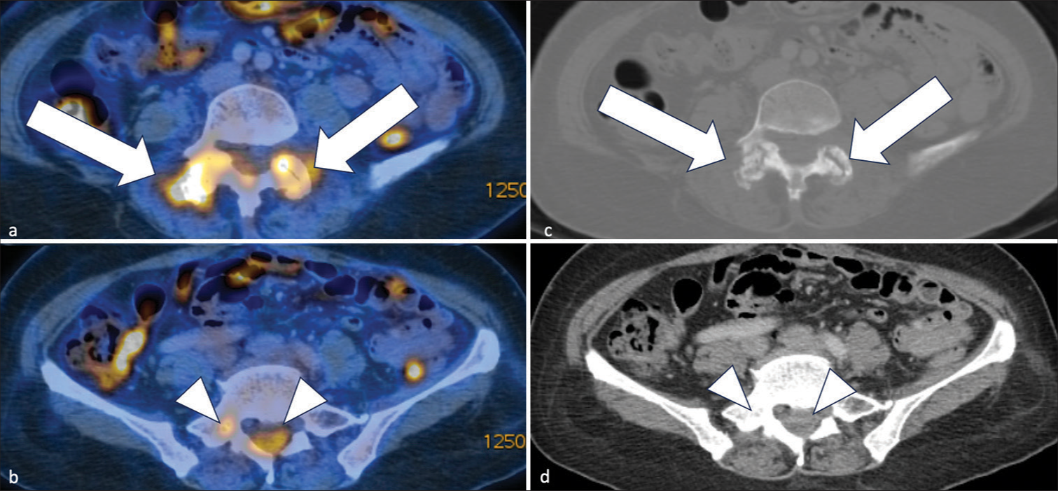 A 60 years old lady with 1 week onset of fever of unknown origin, low back pain and mild bilateral lower limb weakness. (a and b) Axial images of positron emission tomography–computed tomography whole body. It showed hypermetabolic erosion of bilateral L4/5 articular processes with narrowing of joint space (white arrows); (c and d) They showed increased fluorodeoxyglucose (FDG) uptake at right L5 lamina (Left arrowheads in c and d, respectively). There was increased FDG uptake of adjacent spinal canal at L5 level with corresponding hypodense epidural collection (right arrowheads in c and d, respectively).