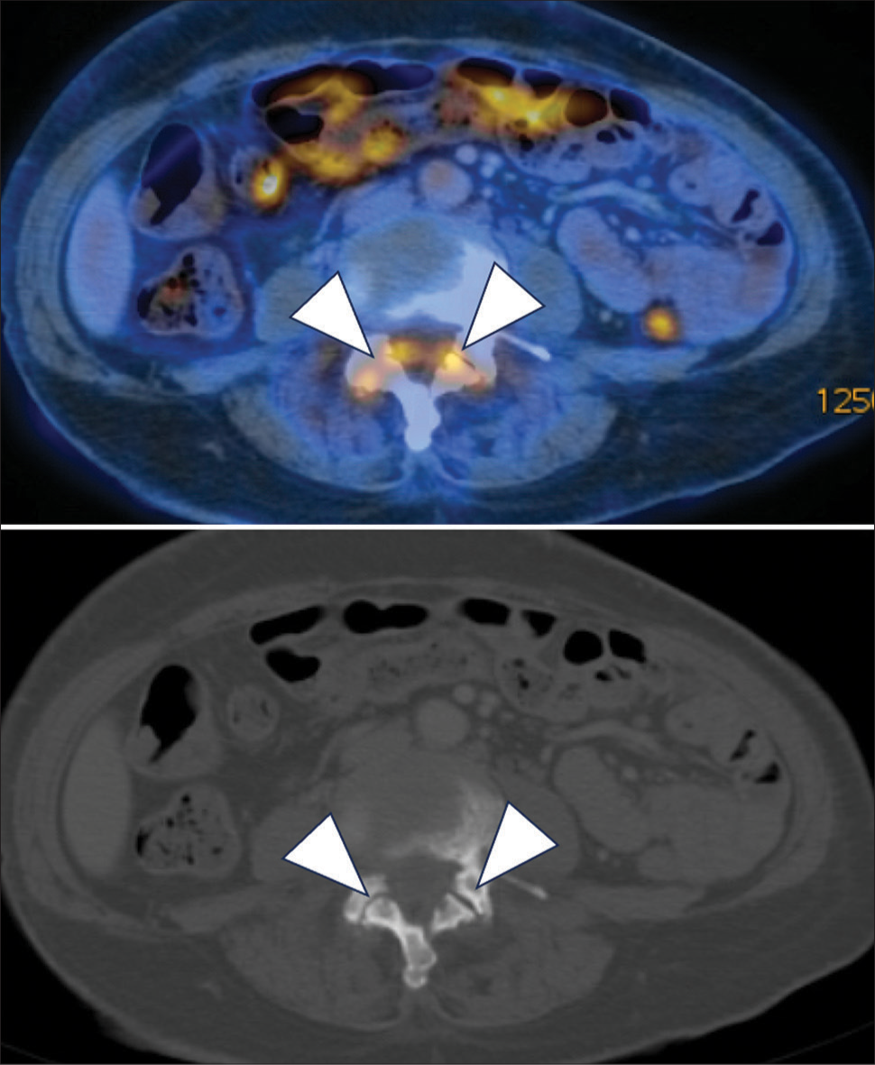 A 60 years old lady with 1 week onset of fever of unknown origin, low back pain and mild bilateral lower limb weakness. Axial images of positron emission tomography– computed tomography whole body. There was mild fluorodeoxyglucose (FDG) uptake at bilateral L3/4 facet joints (white arrowheads) suggestive of degenerative changes.