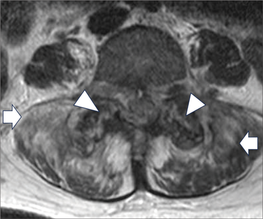 A 79 years old lady with history of cervical myelopathy and worseninnng neck pain for a few weeks. Axial image of T2-weighted magnetic resonance imaging lumbosacral spine. It showed erosion of bilateral L4/5 facet joint surfaces (white arrowheads). Adjacent paraspinal muscle edema was observed at the bilateral L4/5 facet joints (short white arrows), with the right side being more severely affected.