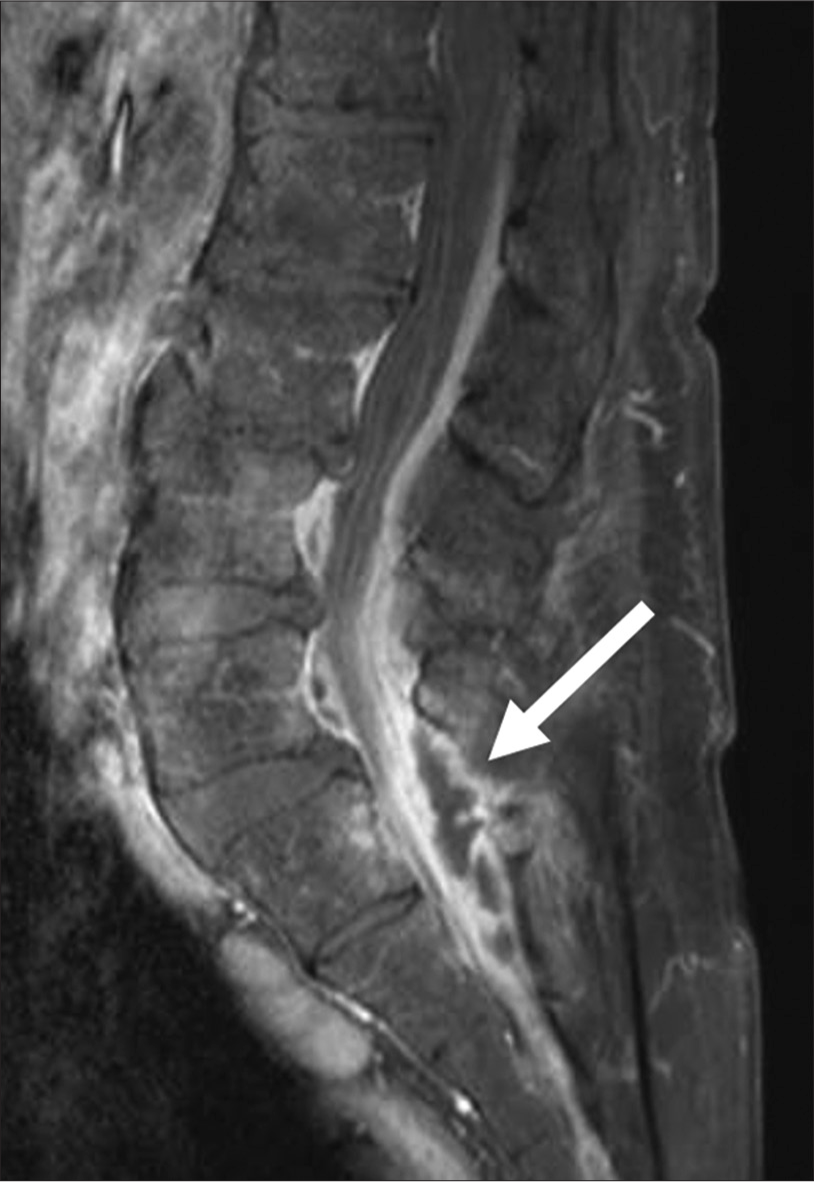 A 79 years old lady with history of cervical myelopathy and worseninnng neck pain for a few weeks. Sagittal image of T1-weighted fat suppressed gadolinium-enhanced MR images of lumbosacral spine. Sacralization of L5 vertebra was noted. It showed epidural abscess with epicenter at L5 level (white arrow).