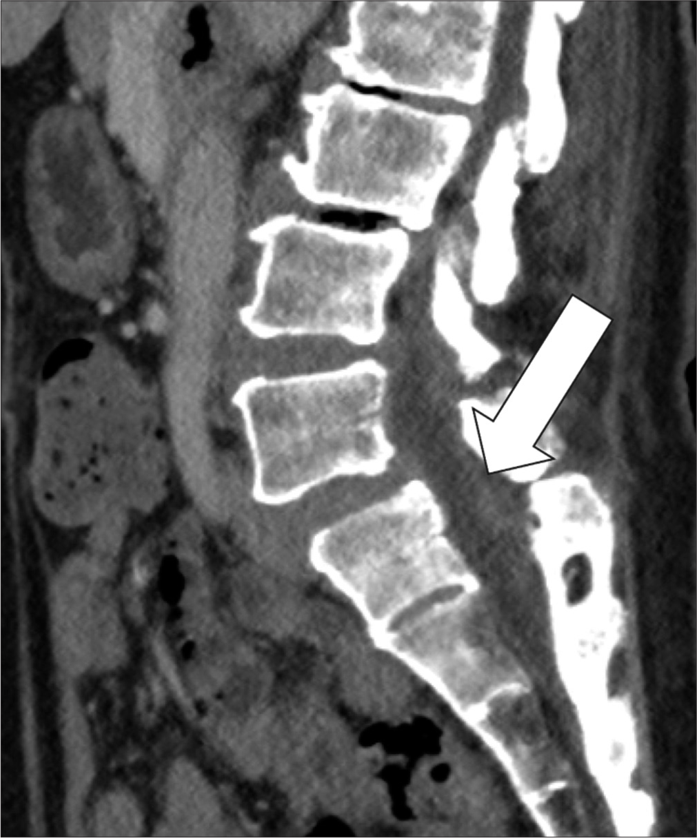 A 79 years old lady with history of cervical myelopathy and worseninnng neck pain for a few weeks. Follow-up sagittal images of contrast computed tomography lumbosacral spine after treatment. It showed the epidural abscess had resolved (white arrow).