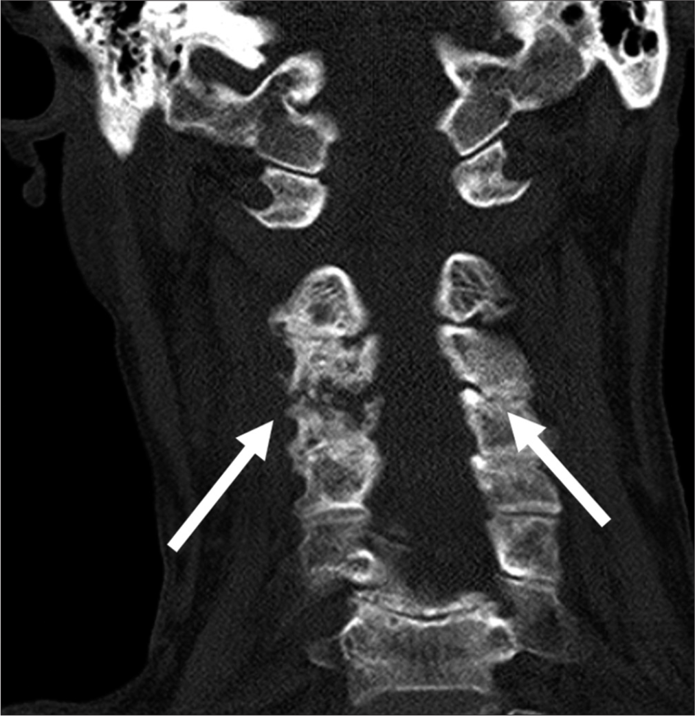 A 79 years old lady with history of cervical myelopathy and worseninnng neck pain for a few weeks. Coronal images of plain computed tomography cervical spine. It showed right C3/C4 facet joint destruction and widening (white arrows).