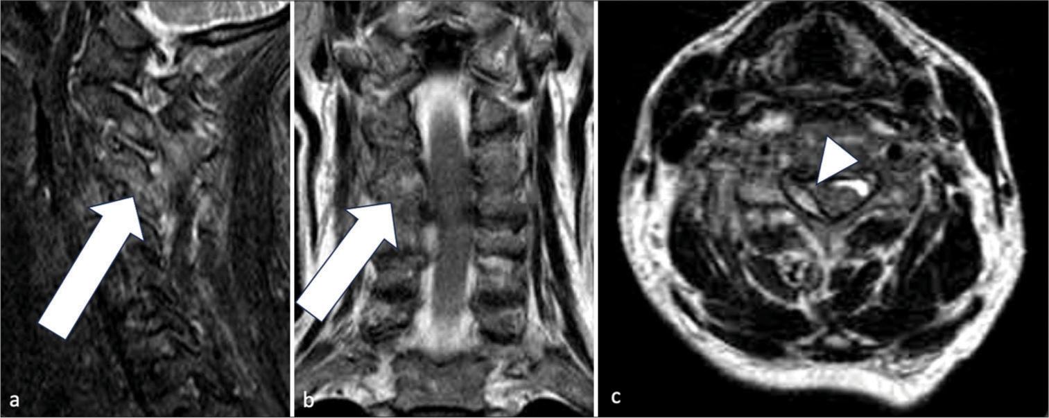 A 79 years old lady with history of cervical myelopathy and worseninnng neck pain for a few weeks. (a and b) Sagittal (with fat suppression), coronal, and axial (without fat suppression) images of T2 weighted magnetic resonance imaging cervical spine. They showed the right C3/4 facet joint surface irregularities with increased T2 hyperintense signals over articular processes (white arrows); (c) Epidural abscess was also noted at the right C5 level (white arrowhead).