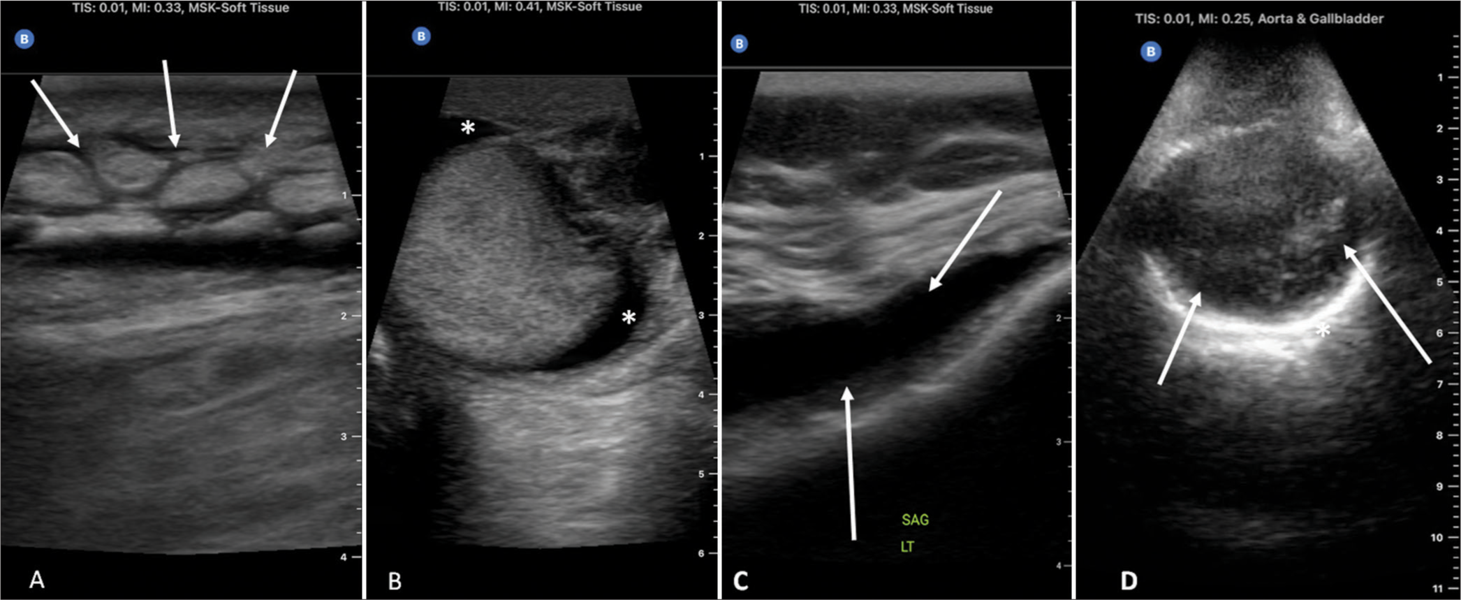 Representative ultrasound images: (A) Cobblestoning in the right calf with arrows pointing to the edema in the soft tissue, (B) right testicular hydrocele with areas of fluid noted by the asteriks*, (C) left knee effusion with arrows pointing to the anechoic fluid pocket, and (D) abdominal aortic aneurysm with a calcified wall* and intramural thrombus denoted by the arrows.