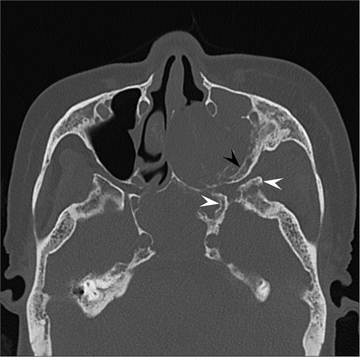 A 73-year-old woman with meningioma who presented with the left cheek swelling. Axial computed tomography image shows hyperostosis in the left sphenoid (white arrowheads) and maxillary (black arrowhead) bones.