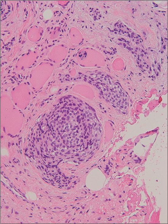 A 73-year-old woman with meningioma who presented with the left cheek swelling. Hematoxylin and eosin stained image shows tumor cells with round nuclei proliferating in whorl formation. Eosinophilic cytoplasmic invaginations, also known as intranuclear pseudoinclusions, were detected. Few mitotic figures and necrosis w ere noted. Hematoxylin and eosin stained image (×100 magnification)