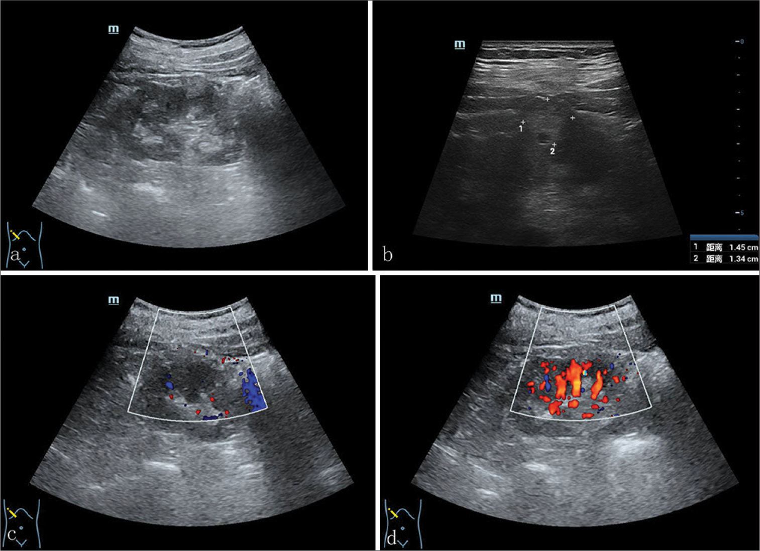 A 71-year-old male presented with a case with TRCC who underwent a conventional ultrasound showed conventional ultrasound showed (a) a 1.4 × 1.3 × 1.1-cm hyperechoic, regular nodule in the middle right renal parenchyma. No obvseptum was observed in the nodule. (b) An internal small anechoic area with a range of 0.2 × 0.3-cm could be observed. CDFI exhibited (c) no obvious blood flow signal in the nodule, (d) that the signal in the renal parenchyma around the nodule increased, showing a pattern of branching detour. (TRCC: Tubulocystic renal cell carcinoma, CDFI: Color doppler flowing imaging)