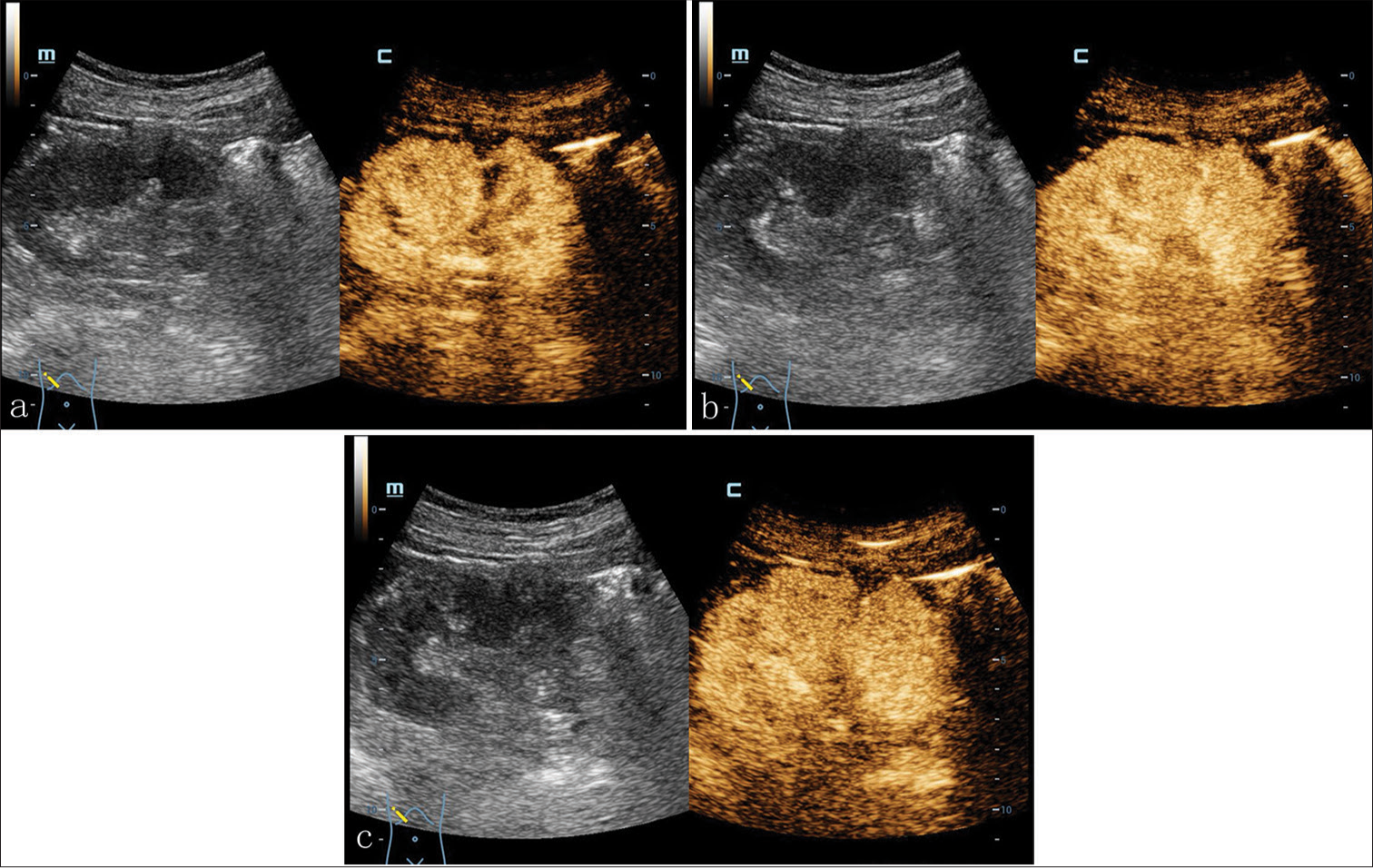 A 71-year-old male presented with a case with TRCC. Contrast-enhanced ultrasound showed nodular uneven enhancement with a range of 0.2 × 0.6-cm in the middle right renal parenchyma, and non-enhancement in the remaining parts. The infiltration of contrast agent could be seen at margin of lesion and the enhancing portion was cystic wall connected to the renal parenchyma. (a-c) The enhancing intensity of thicken cystic wall at peak phase approached to that of renal parenchyma with fuzzy boundary between them. (TRCC: tubulocystic renal cell carcinoma)