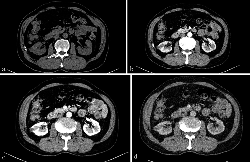 A 71-year-old male presented with a case with TRCC underwent (a) Plain computed tomography (CT) scan which showed slightly low-density, multilocular cystic-dominant lesion (average cycle threshold [CT] value: 21.17 hounsfield unit (HU), range of CT value: −16.65HU). (b-d) Contrast-enhanced CT showed the degree of enhancement decreased gradually in renal cortex phase (range of CT value: −30.89 HU), nephrographic phase (range of CT value: −17.104 HU), and excretory phase (range of CT value: −23.98 HU), presenting the profile of heterogeneously mild contrast enhancing. (TRCC: Tubulocystic renal cell carcinoma)