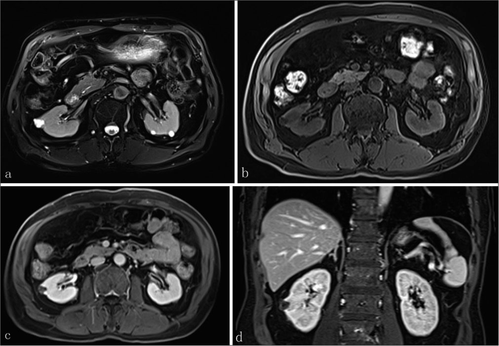 A 71-year-old male presented with a case with TRCC underwent (a) Magnetic resonance (MR) imaging that showed irregular tumor consisting of multiple small cysts with thickened septa on T2-weighted images, presenting heterogeneous water-like signal of cystic fluids. (b) No-enhancing in cystic parts of tumor was observed in MR axial plain scan, (c) axial contrast-enhanced scan, and (d) coronal contrast-enhanced scan. (TRCC: tubulocystic renal cell carcinoma)