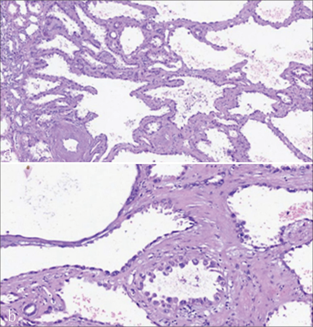 A 71-year-old male presented with a case with TRCC who underwent a pathological examination exhibited (a) representative structure of tubulocystic renal cell carcinoma. (b) It was composed of the typical tubules or cystic components lined by a single layer of epithelial cells, and the nuclei were irregularly enlarged with prominent nucleoli (Hematoxylin and eosin stain a:×100 magnification, b:×400 magnification).