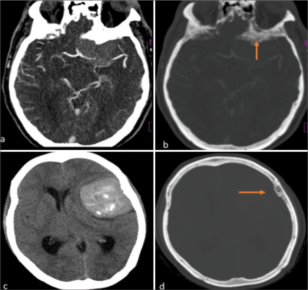 (a): Axial post-contrast CT brain image of a 46-year-old male, showing a well-defined enhancing hyperdense sphenoid wing meningioma with adjacent hyperostosis of the sphenoid bone. (b) Reformatted CT bone window of the same patient, showing hyperostosis of the sphenoid bone more clearly (orange arrow). (c) Axial non-contrast CT image of a 55-year-old female, demonstrating a hyperdense lateral convexity meningioma. (d) Reformatted CT bone window of the same patient, showing adjacent osseous reaction with subtle hyperostosis of the left parietal bone (orange arrow).