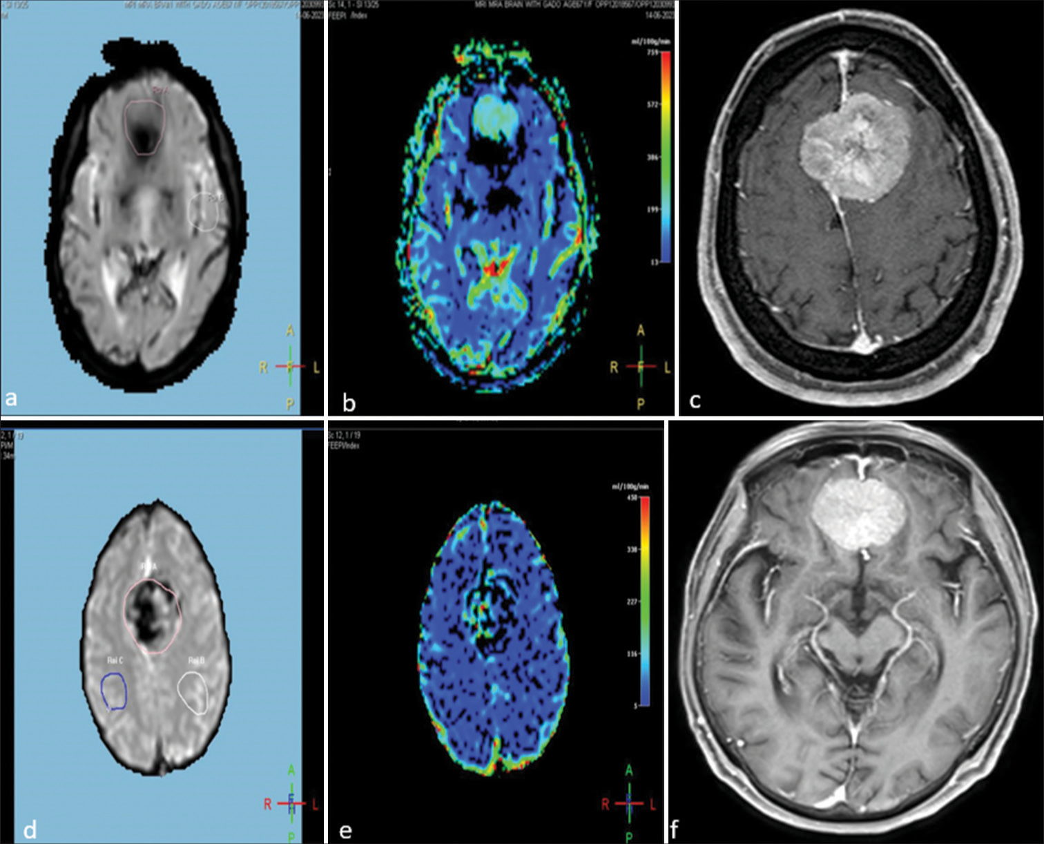 Imaging of a 43-year-old female and a 51-year-old male with homogeneously enhancing bifrontal meningiomas, demonstrating perfusion characteristics and post-contrast enhancement. (a and b) Perfusion-weighted images of the 43-year-old female. (a) Light pink circle indicating the region of interest (ROI) at the tumor site and a white circle representing the ROI in the normal parenchyma. (b) Raised cerebral blood volume (CBV) at the tumor site, demonstrating increased perfusion. (c) Post-contrast T1-weighted image illustrating homogeneous and intense enhancement of the meningioma. (d and e) Perfusion-weighted images of the 51-year-old male. (d) Light pink representing the ROI at the tumor site and blue and white circles representing the ROI at the normal parenchyma. (e) Increased CBV at the tumor site, demonstrating increased perfusion. (f) Post-contrast T1-weighted image of the 51-year-old male, showing homogeneous and intense enhancement of the meningioma.