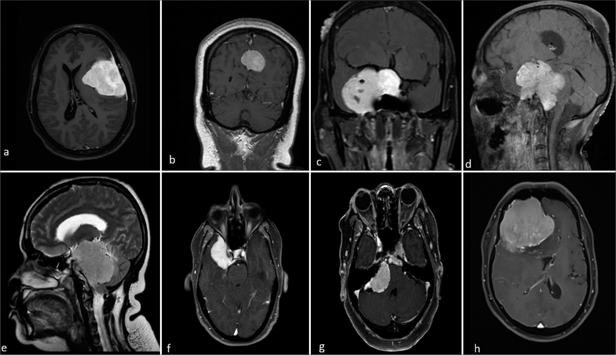 Magnetic resonance imaging post-contrast images of different patients with meningioma at typical and atypical locations. (a) Lateral convexity meningioma, (b) parasagittal meningioma, (c) sphenoid wing meningioma, (d) sella turcica meningioma, (e) posterior cranial fossa meningioma, (f) middle cranial fossa meningioma, (g) cerebello-pontine angle meningioma, and (h) anterior cranial fossa meningioma.