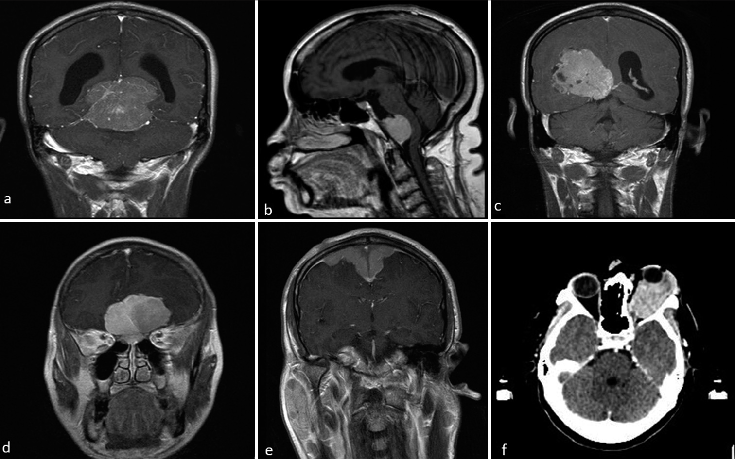 Magnetic resonance imaging post-contrast images of different patients with meningioma at atypical locations. (a) Tentorial meningioma, (b) retroclival meningioma, (c) intraventricular meningioma, (d) bifrontal meningioma, (e) en-plaque type meningioma, and (f) axial computed tomography brain showing optic nerve meningioma.