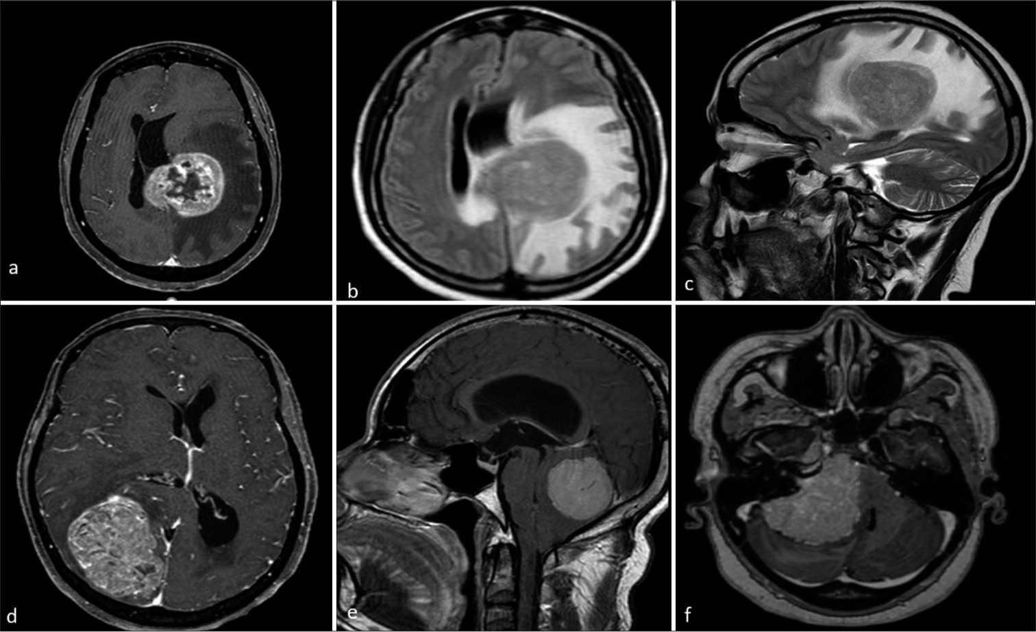 Magnetic resonance (MR) imaging of different patients with meningioma showing atypical features. (a-c) MR axial post-contrast image showing left parasagittal meningioma with central non-enhancing necrotic areas axial and sagittal T2W images show parasagittal meningioma with moderate to gross perilesional edema. (d) Axial post-contrast image shows meningioma causing significant mass effect by compressing adjacent cortical areas and causing midline shift. (e and f) Sagittal and axial post-contrast images show posterior fossa and cerebello-pontine angle meningioma causing compression of brainstem and fourth ventricle with tonsillar herniation and hydrocephalus.