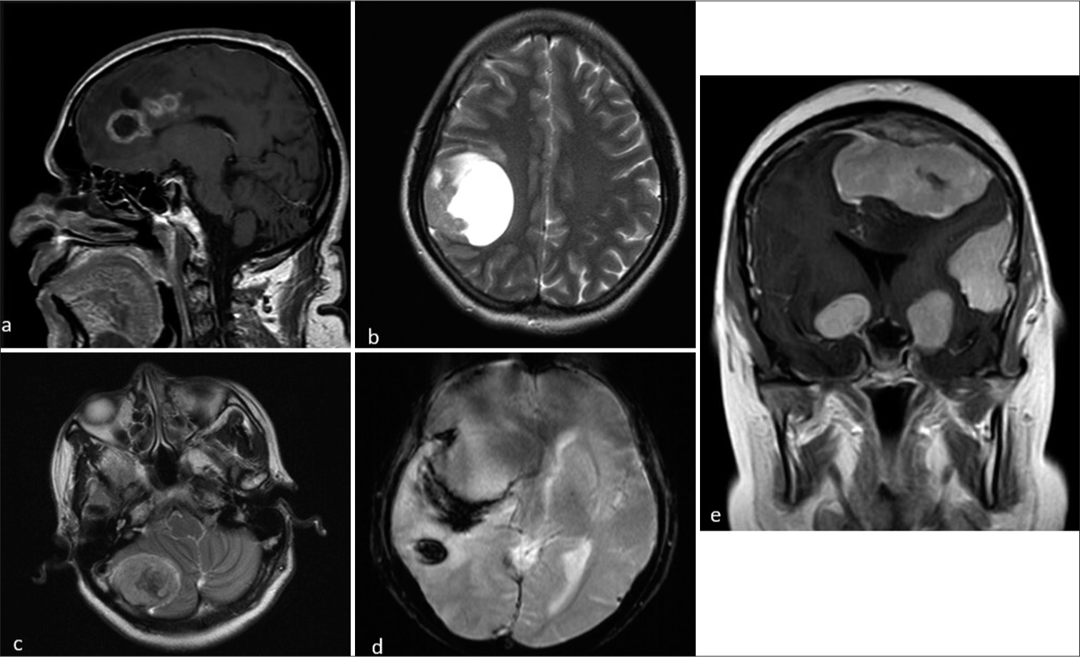 Magnetic resonance imaging of different patients with meningiona showing atypical features. (a and b) Sagittal post-contrast and axial T2-weighted (T2W) images showing meningioma with cystic changes. (c and d) Axial T2W and susceptibility-weighted imaging sequences showing meningioma with intra tumoral hemorrhage and intracerebral hemorrhage. (e) Coronal contrast images shows multiple meningioma involving supra and infratentorial regions.