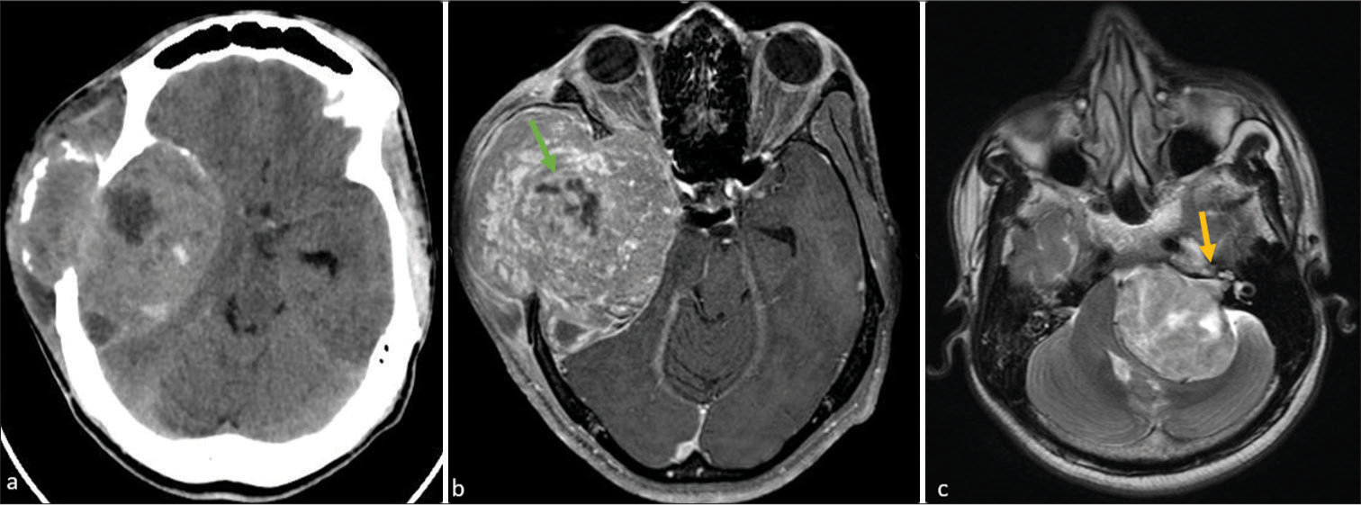 (a) Axial computed tomography shows a large ill-defined lobulated heterogeneous mixed-density extra-axial mass noted in the right parietal-temporal region with adjacent bone destruction. (b) On post-contrast T1-weighted magnetic resonance imaging show the lesion heterogeneous enhancement with prominent internal flow voids (straight green arrow). (c) Axial T2-weighted image showing a large heterogenous extra-axial mass in the left cerebellopontine angle causing compression and displacement of the left cerebellar hemisphere, pons, as well as fourth ventricle. Note that mass arises within the right internal auditory meatus causing its widening (straight yellow arrow).