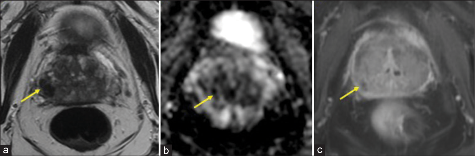 A 70-year-old male with bacillus Calmette–Guérin granulomatous prostatitis who presented with elevated prostate-specific agent. (a) Magnetic resonance imaging (MRI) of the prostate, axial T2-weighted imaging: By prostate imaging–reporting and data system (PI-RADS) criteria, the lesion’s (yellow arrow) imaging features are most compatible with PI-RADS 4 (High-clinically significant prostate cancer is likely to be present). (b) MRI of the prostate, axial apparent diffusion coefficient: The right prostate base lesion (yellow arrow) restricts diffusion and demonstrates non-enhancing core. (c) MRI of the prostate, post contrast T1: By PI-RADS criteria, the lesion’s (yellow arrow) imaging features are most compatible with PI-RADS 4 (High-clinically significant prostate cancer is likely to be present).