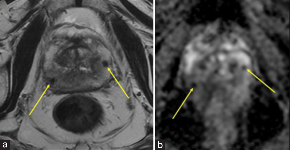 A 70-year-old male with bacillus Calmette–Guérin granulomatous prostatitis who presented with elevated prostate-specific agent. (a) Magnetic resonance imaging of the prostate with and without contrast, axial T2-weighted image shows additional multifocal lesions (yellow arrows) in the peripheral zone, measuring 5 mm or less. No abnormal enhancement. (b) Apparent diffusion coefficient image shows imaging features most compatible with a Prostate Imaging-Reporting and Data System 3 (intermediate - the presence of clinically significant prostate cancer is equivocal) and the peripheral zone multifocal lesions (yellow arrows) seen in (a).