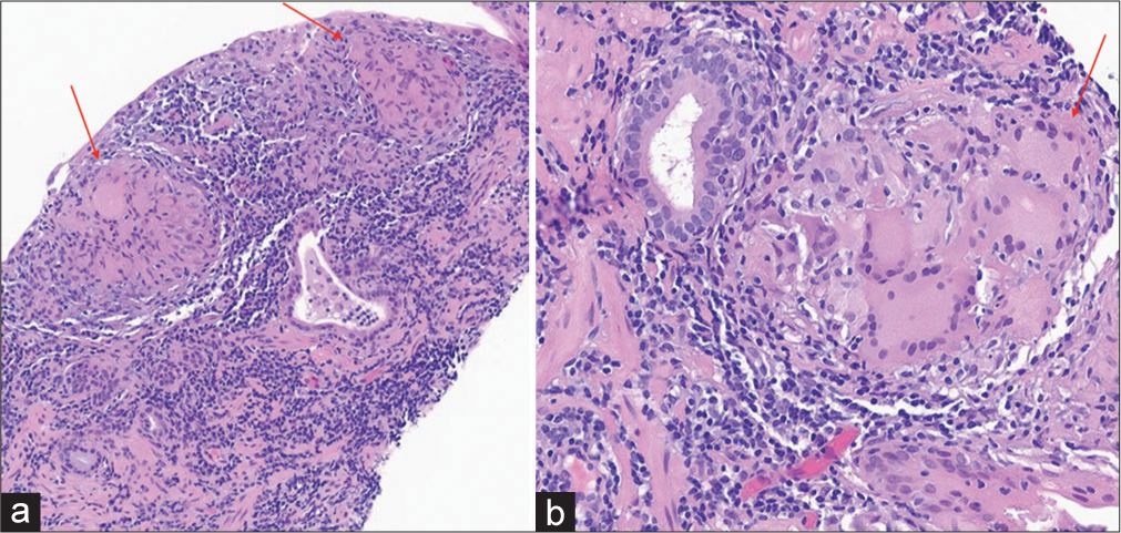 A 70-year-old male with bacillus Calmette–Guérin granulomatous prostatitis who presented with elevated prostate-specific agent. (a) Hematoxylin and eosin (H&E) image at ×200 magnification shows well-formed epithelioid granulomas (red arrows) with a background of chronic inflammation. (b) H&E image at ×400 magnification shows epithelioid granuloma (red arrow) with multinucleated giant cells in a background of chronic inflammation.