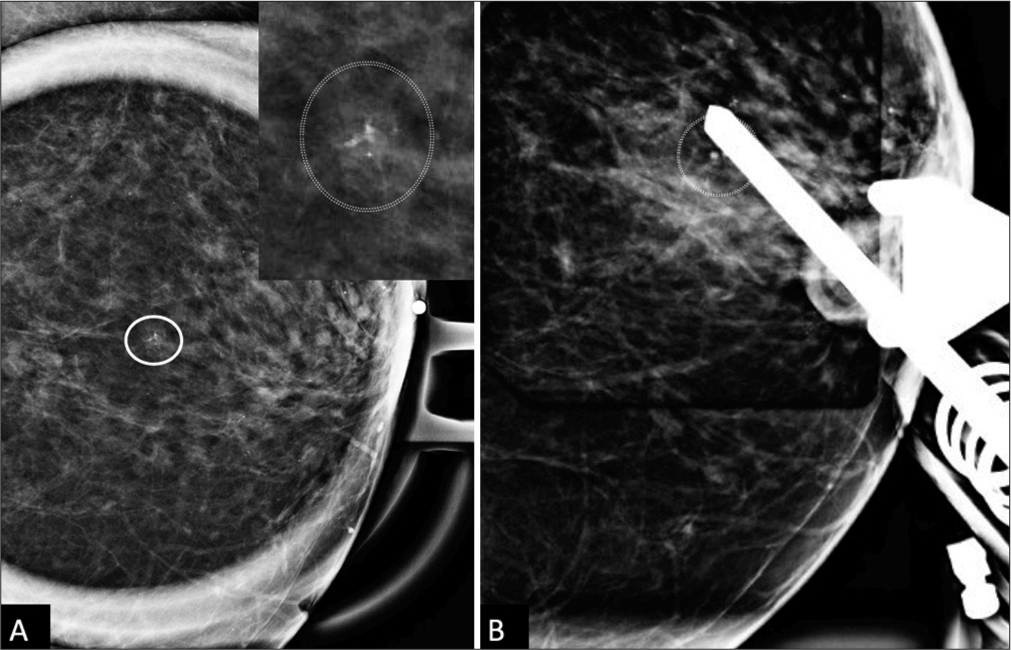 A 66 year old woman’s screening mammogram with Spot magnification left CC view shows a 3mm group of amorphous calcifications (white circle), with further digital magnification in the top right corner for improved resolution. (A) There is no change in the shape of the calcifications in the magnified ML view (not shown). (B) Postfire stereotactic image shows the needle positioned appropriately at the trough, targeting the calcifications.